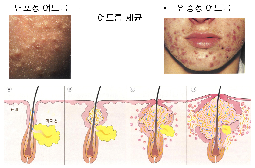 여드름의 염증 기전.jpg