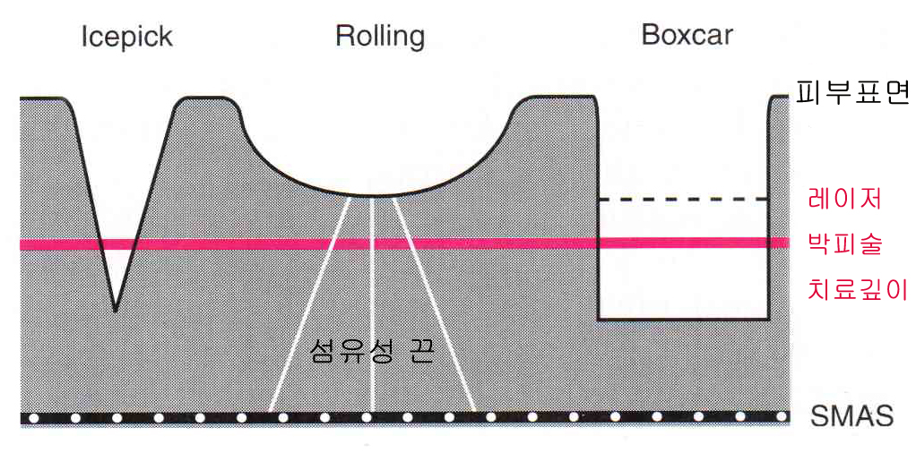 여드름흉터의 형태 분류 그림-최종-002.jpg