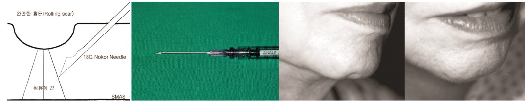 피하박리술 시술.jpg