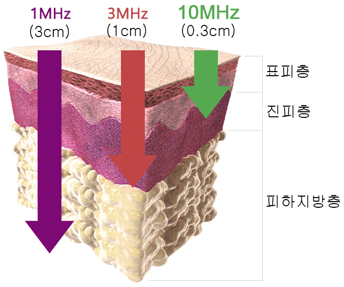 초음파 주파수별 투과 깊이-cnp.jpg