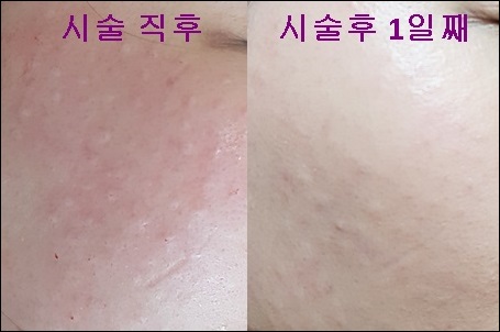 시술직후와 1일째.jpg