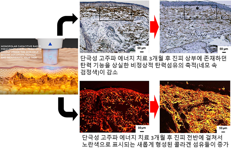 올리지오 콜라겐 재생-cnp-002.jpg