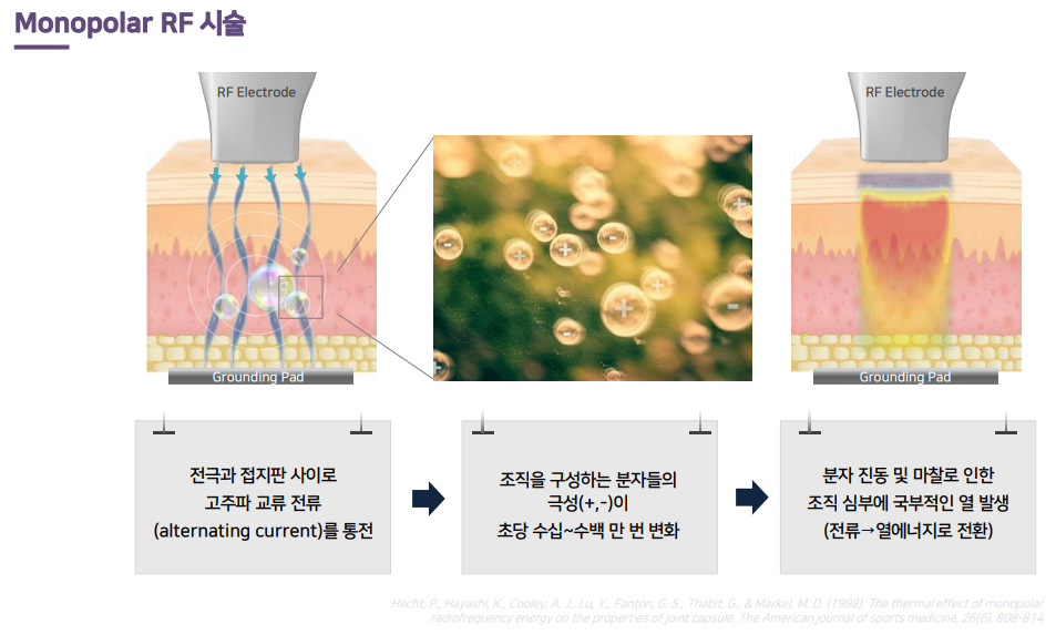 고주파 치료원리.png