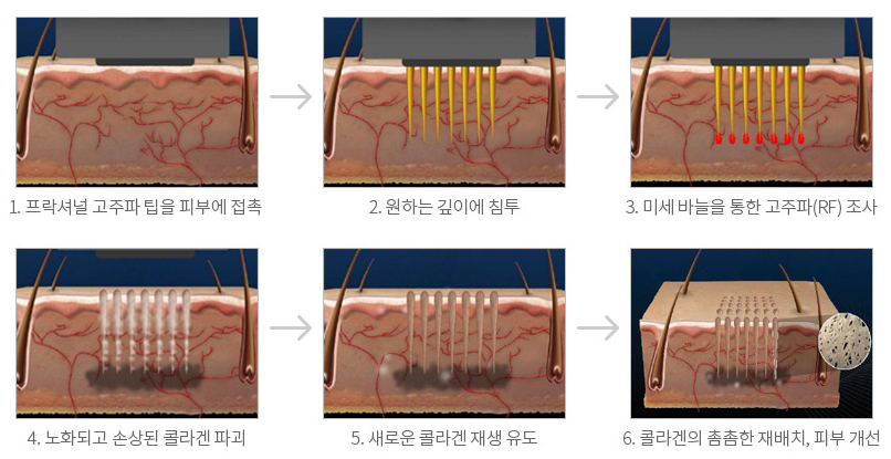 20221129_프락셔널 고주파.PNG