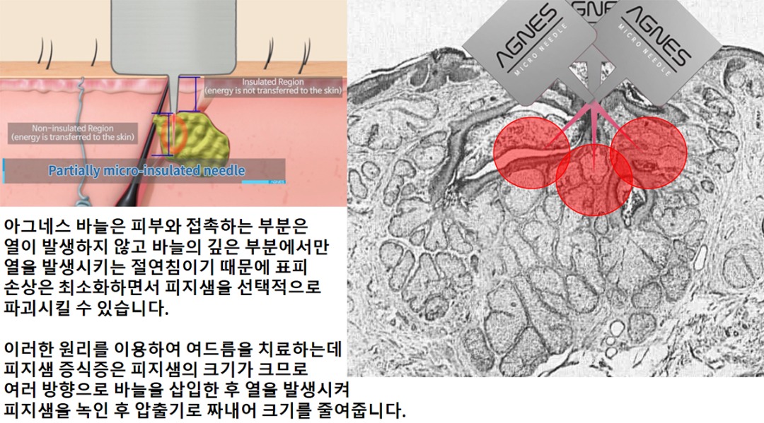 아그네스 치료 방법.jpg