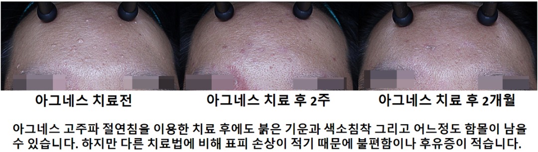 아그네스 치료전후사진002.jpg