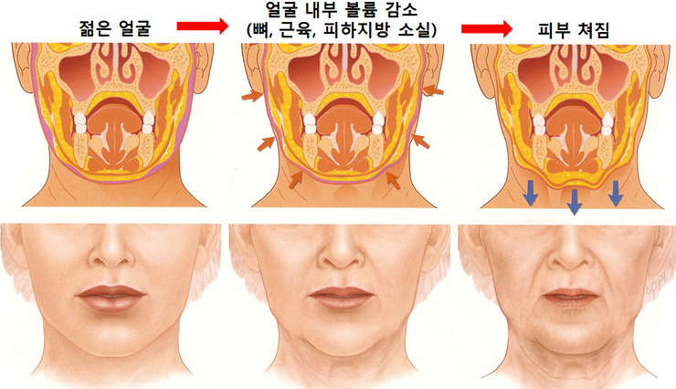 노화과정(턱)-최종-cnp.jpg