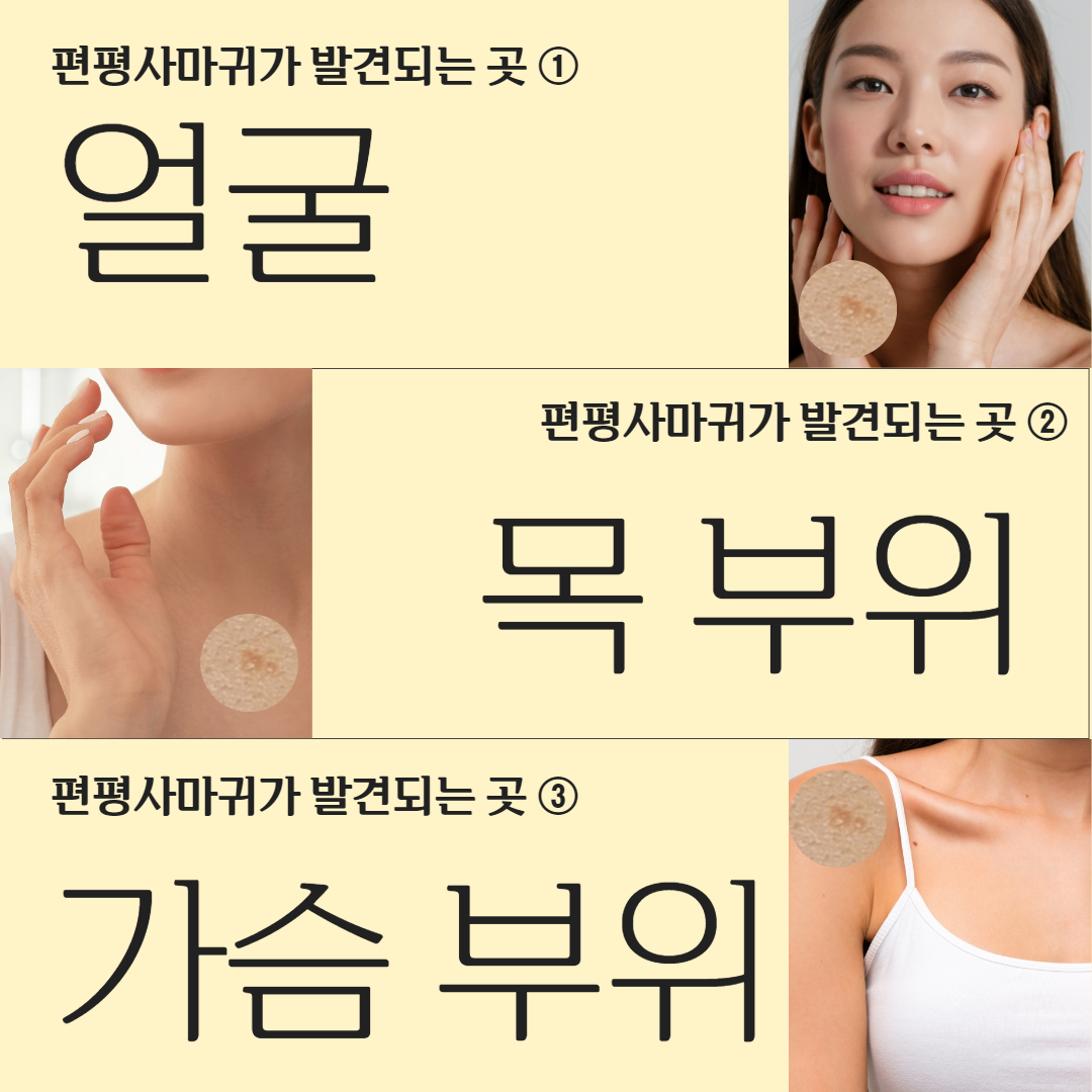 2405_평택칼럼_편평사마귀 2.png