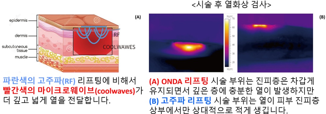 마이크로웨이브 vs 고주파 리프팅.jpg
