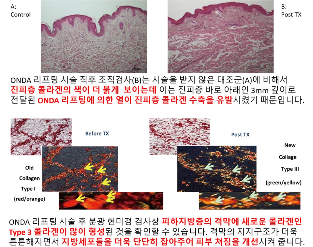 온다리프팅 시술 전후 조직변화.jpg