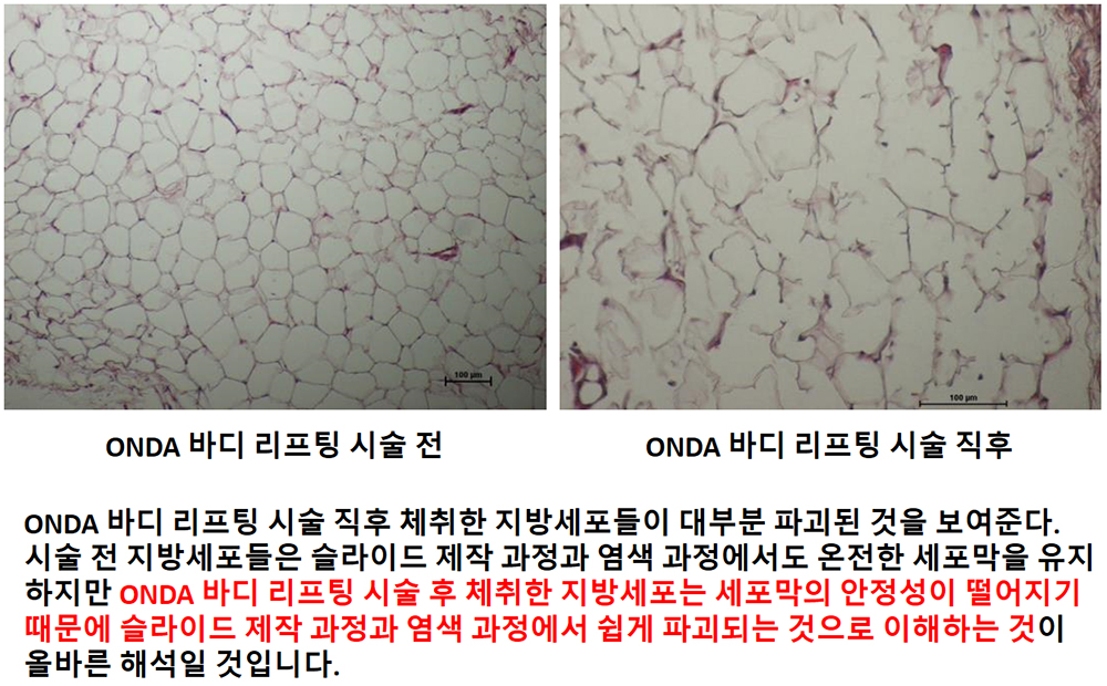 지방세포 파괴.jpg