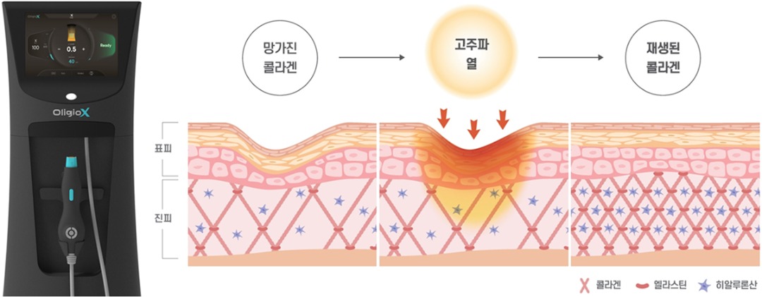 올리지오 사진과 기전.jpg