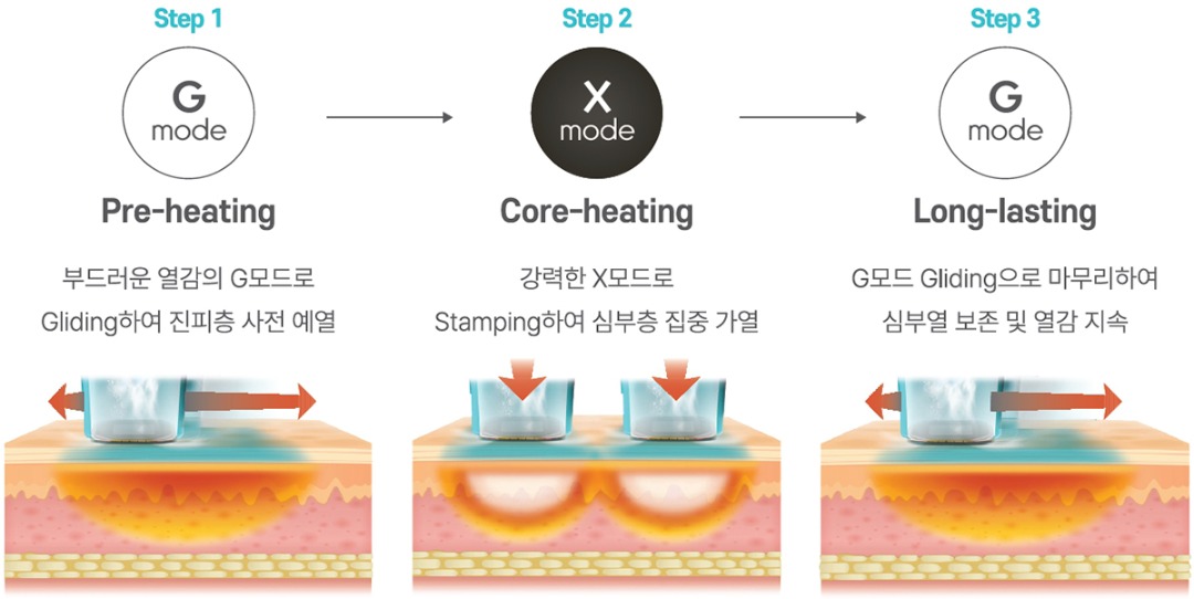 GXG 치료법.jpg