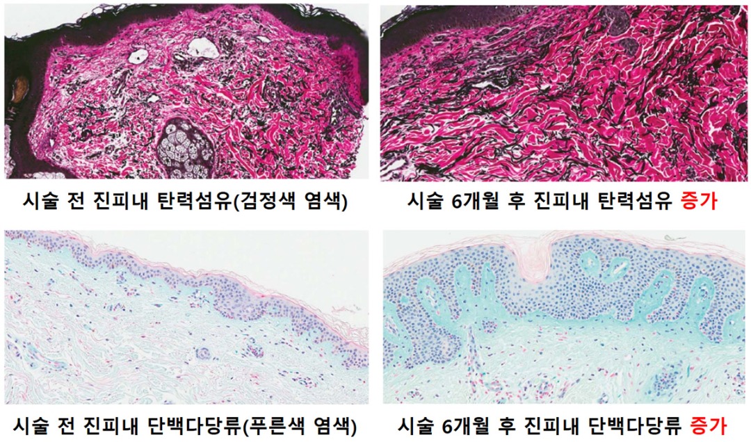 래디어스 시술 6개월 후 조직 변화-cnp.jpg