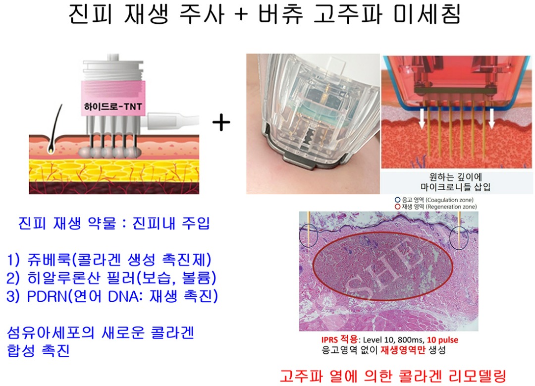 버츄 자가진피재생술.jpg