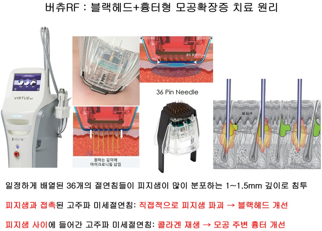 버츄 RF 블랙헤드 흉터형 모공확장증 치료원리-cnp.jpg