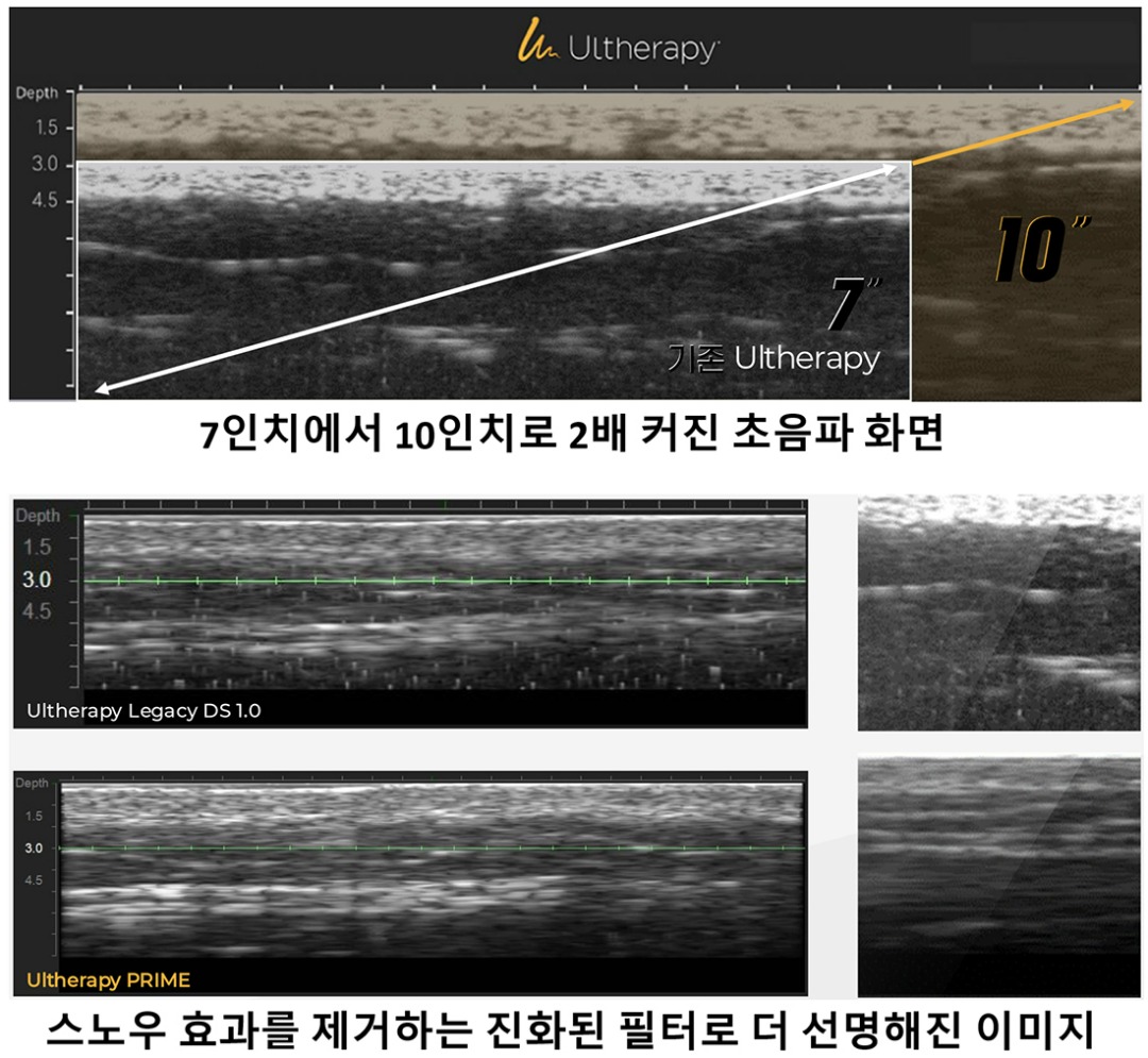 초음파 이미지의변화-cnp.jpg