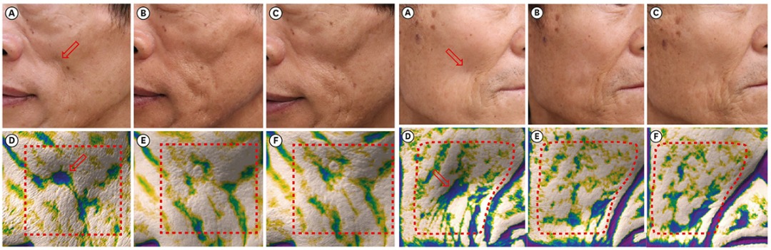 리투오 논문001 전후사진.jpg