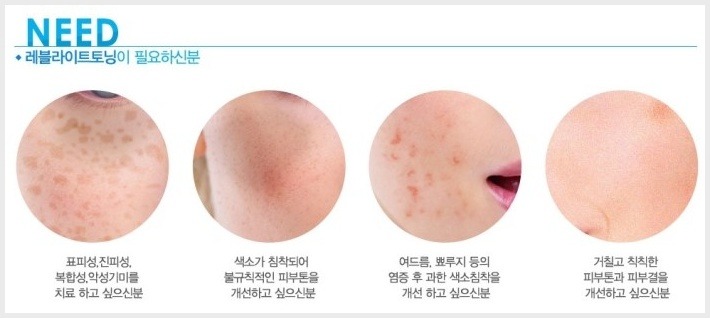 기미, 주근깨, 색소침착 레이저토닝 시술후기 1 (플랙셀 듀얼, BBL 쥬레이저, 레브라이트) 9