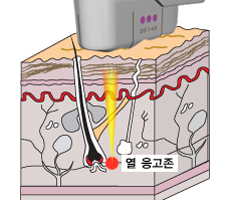 초음파 리프팅