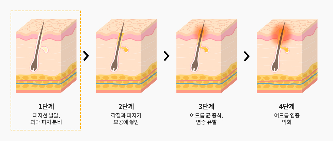 여드름 발생 진행과정