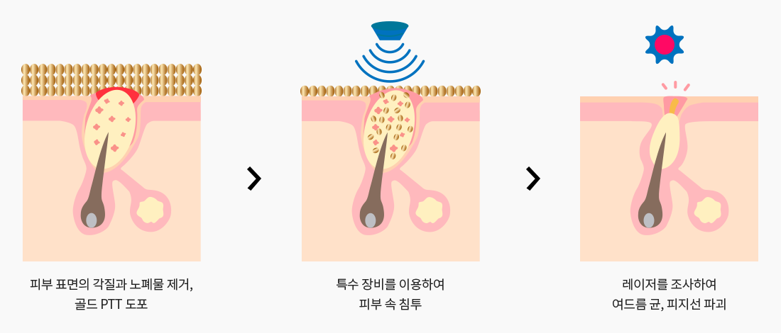 치료과정