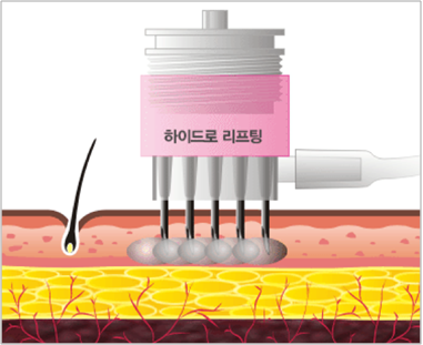 하이드로 리프팅