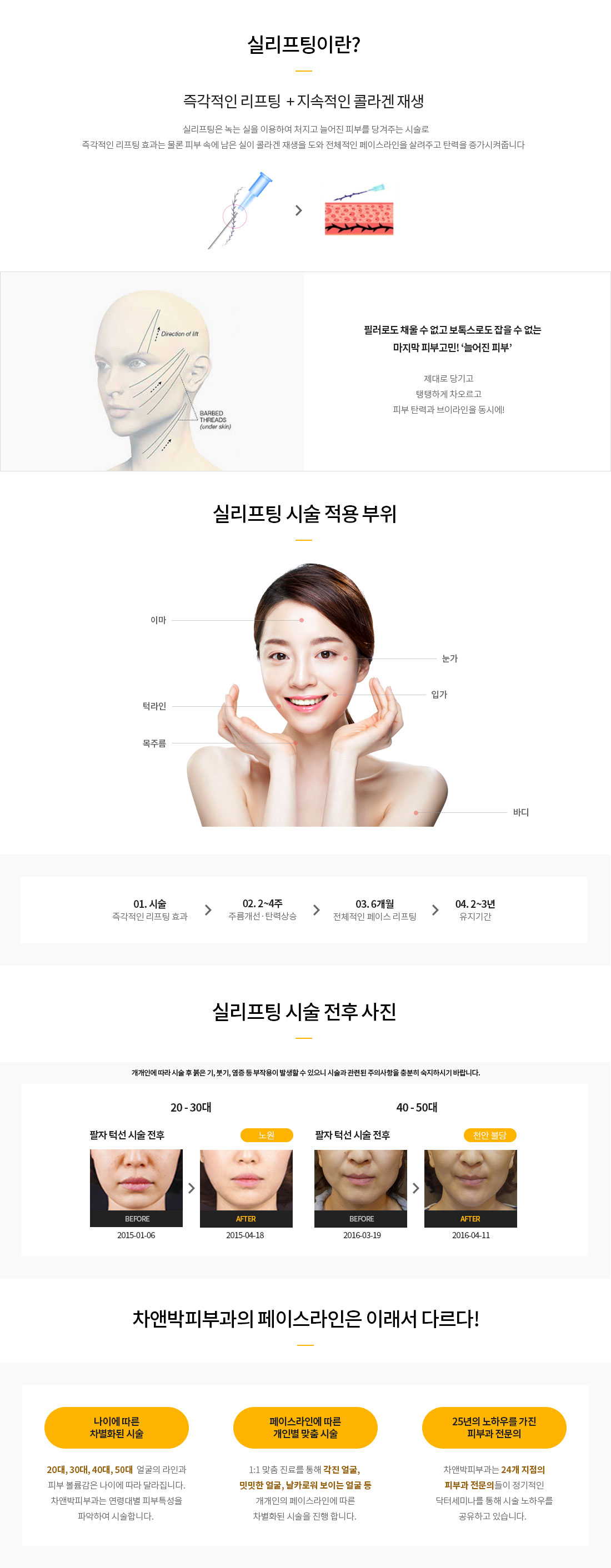 실리프팅이란?