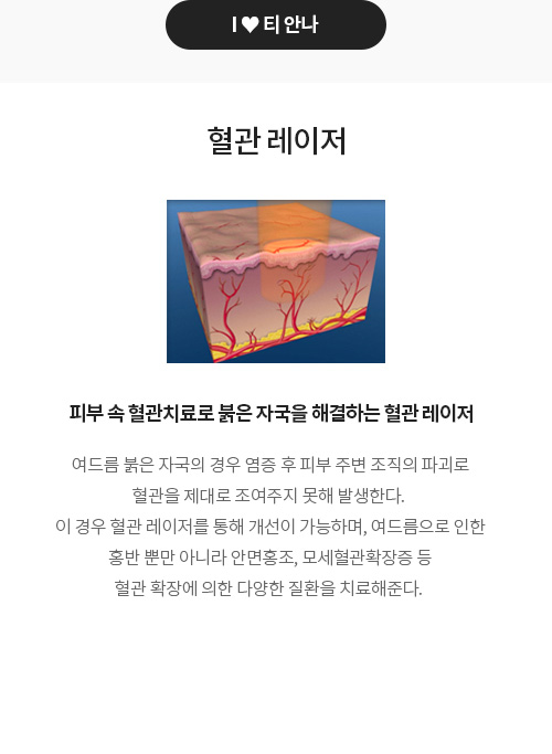 티안나 흉터 혈관 레이저