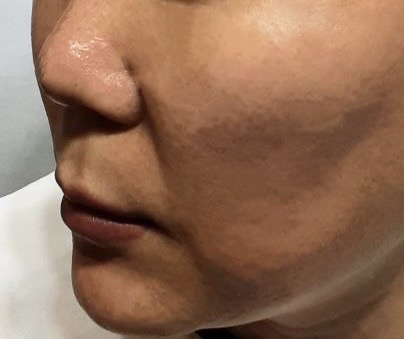 시술후 이미지 