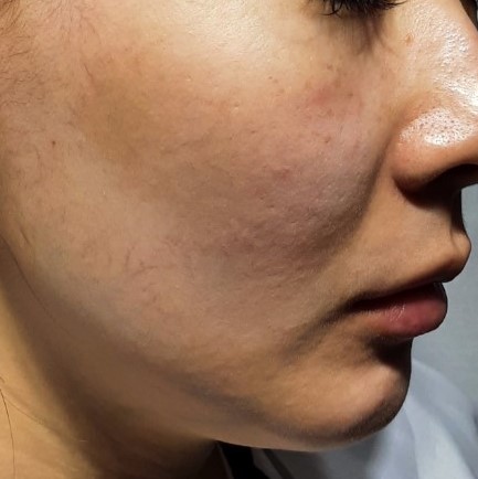 시술전  이미지 