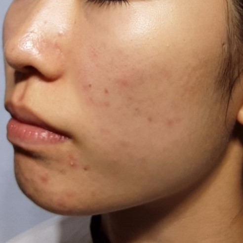 시술전  이미지 