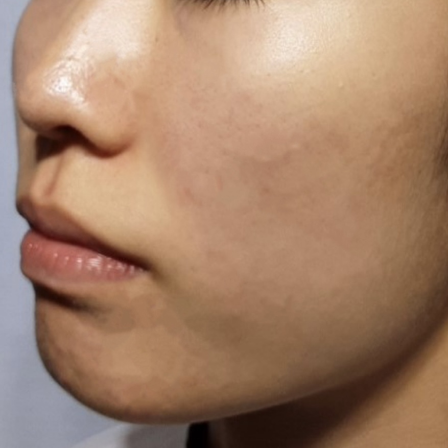 시술후   이미지