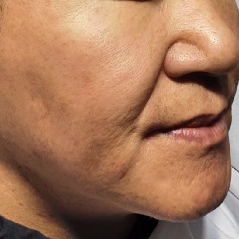 시술후   이미지