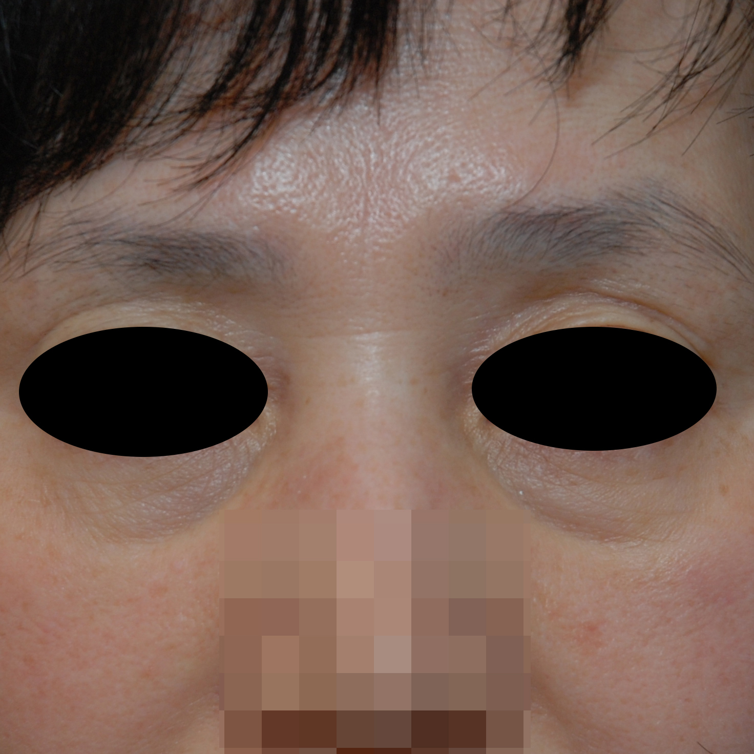 시술후   이미지