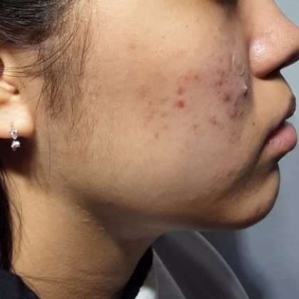 시술전  이미지 